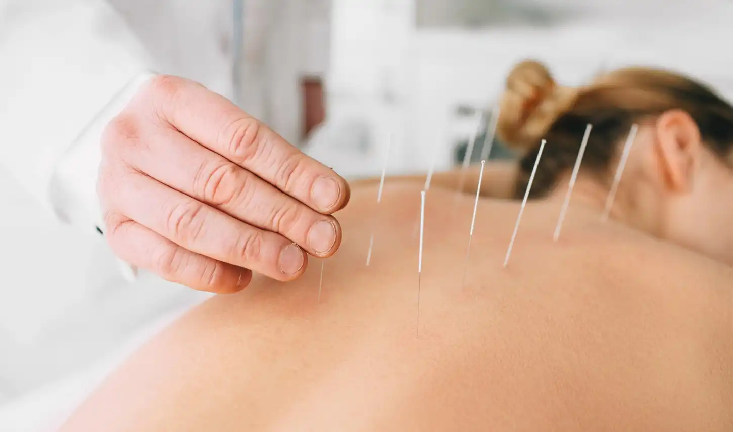 Acupuntura a domicilio